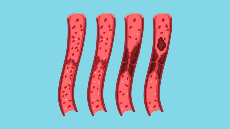 Management of Deep Vein Thrombosis (DVT) When is Surgery Necessary